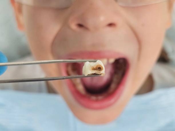 Best Emergency Wisdom Teeth Removal in North Aurora, IL